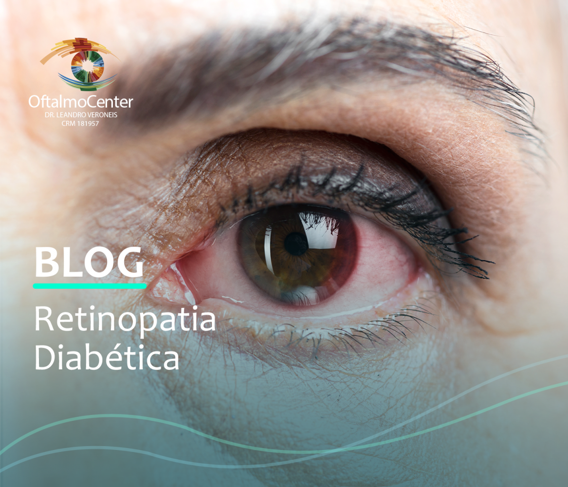 Retinopatia Diabética: o que é?